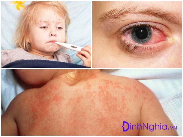 dấu hiệu và triệu chứng sốt siêu vi ở trẻ