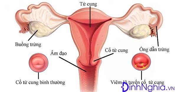 tìm hiểu bệnh viêm lộ tuyến cổ tử cung là gì 